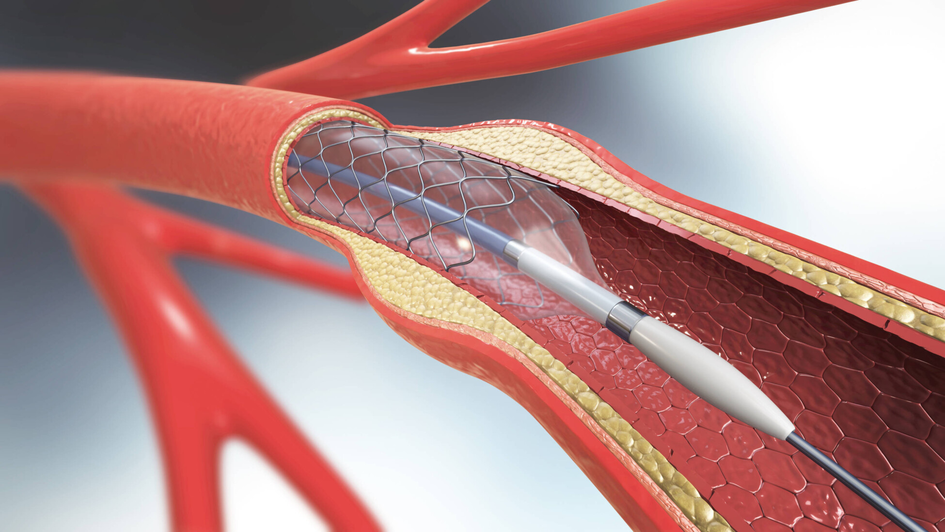 Revascularization